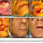 Mucoepidermoid carcinoma Lip