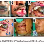 Squamous Cell Carcinoma Lip